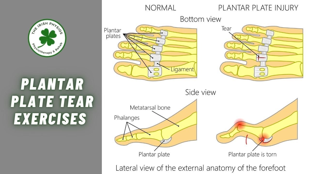 Plantar Plate Tear Exercises